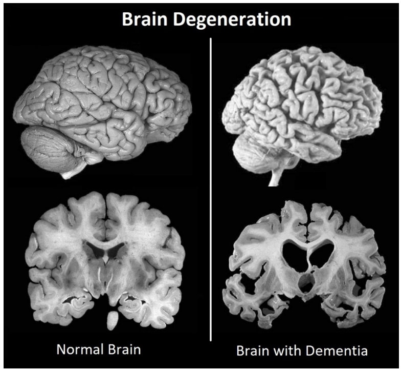 Brain Degeneration
